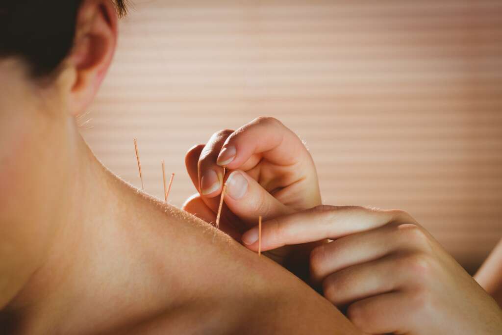 Woman receiving acupuncture treatment